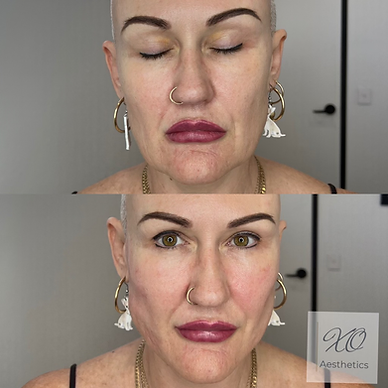 Before and after jowl lift