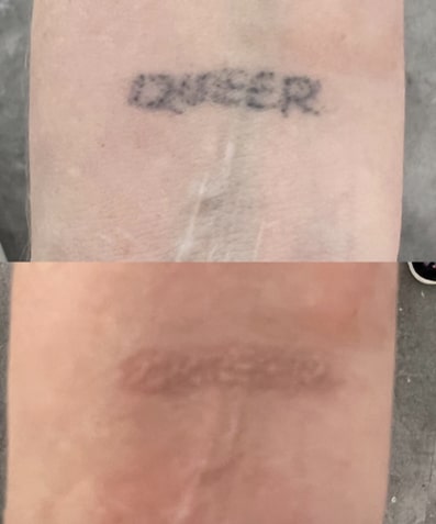Tattoo Removal Before & After